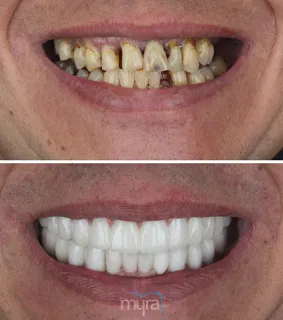 Teeth Turkey Pictures for an all on 4 case. In this case he got 28 crowns over implants and get a full mouth rehabilitation.