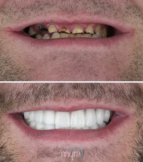Teeth Turkey Pictures for grinded and clinced teeth reconstruction by 28 crowns and 8 teeth implant.