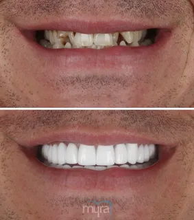 Teeth Turkey Pictures for a narrow smile and a crooked teeth case who had a cross bite. He gets 28 crowns and a aligned smile.