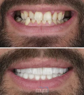 Teeth Turkey Pictures for a narrow smile with cross bite and missing teeth case. He gets a widened smile and correct bite with 27 zirconia crowns.