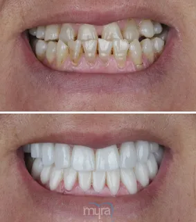 Teeth Turkey Pictures for under bite case correction with full set of crowns.She gets a normal bite and a correct alignment by crowns.