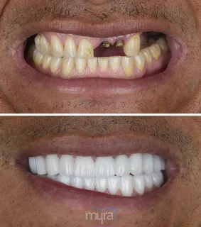Teeth Turkey Pictures of full mouth rehabilitation case by crowns for get a nice smile.