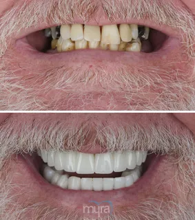 Teeth Turkey Pictures for missign teeth correction case with teeth implants and crowns.