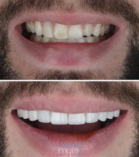 Teeth Turkey Pictures for 24 Emax Laminate Veneers to get a nice smile with minimum preparation.