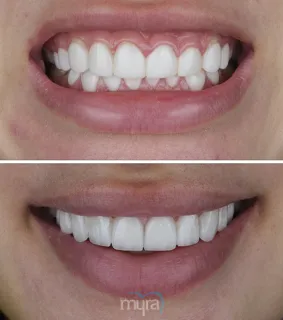 Teeth Turkey Pictures for a composite bonding done case. We finished a beautiful smile with 20 Celtra Veneers.