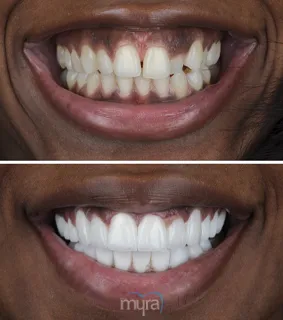 Teeth Turkey Pictures with 1 teeth implants and 24 crowns for a beautiful smile.