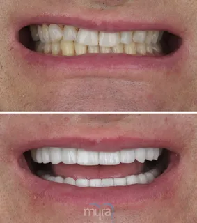 Teeth Turkey Pictures for an irregular and asymetric smile. We did 20 Emax Laminate veneers with BL1 colour.