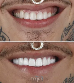 Teeth Turkey Pictures with a smile makeover case with full set of full veneers and 4 teeth implants.