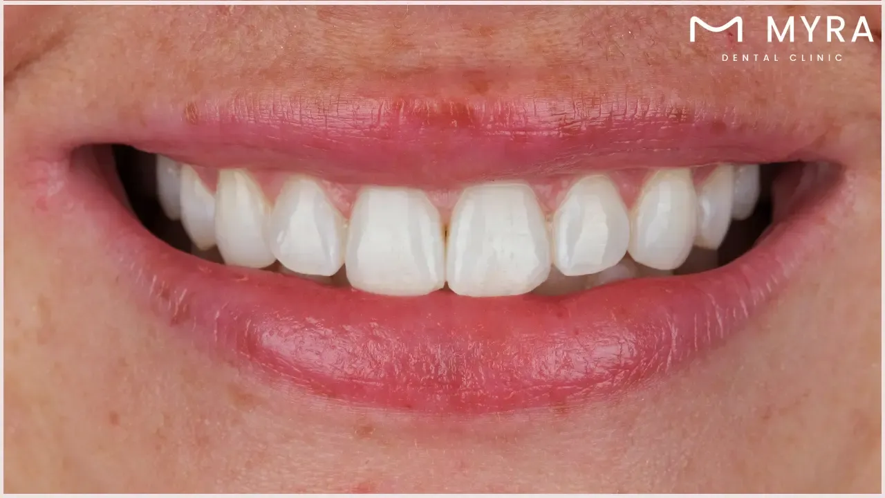 5 risks and considerations of teeth whitening: What you should know