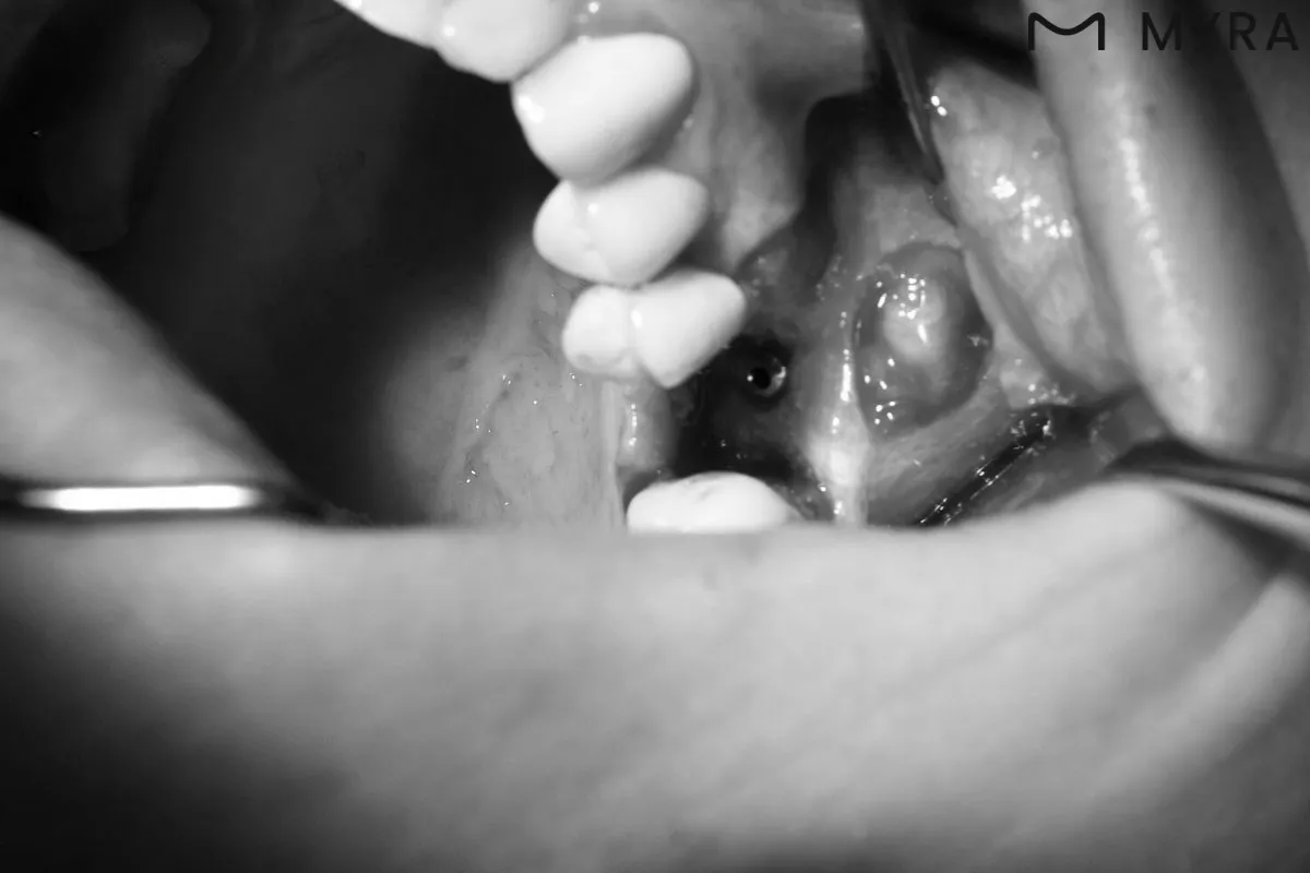 5 teeth extraction and implantplacement