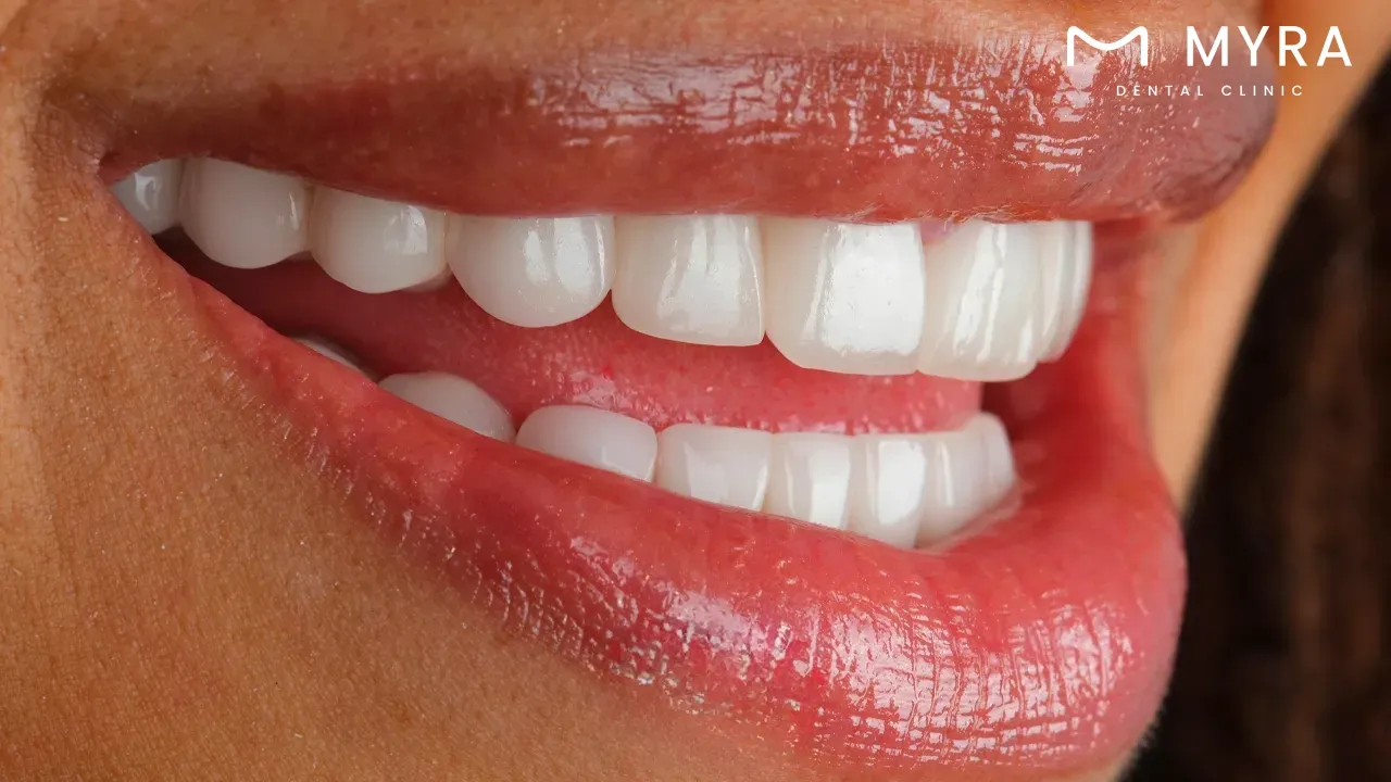 effectively eliminating tooth discoloration
