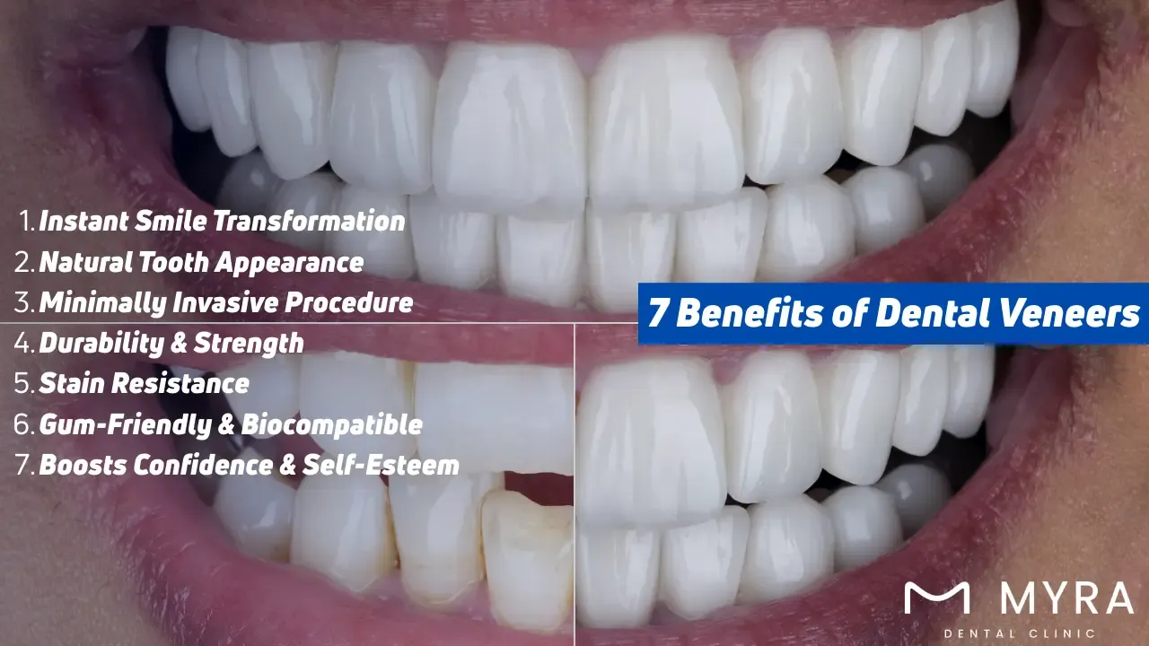 7 benefits of dental veneers