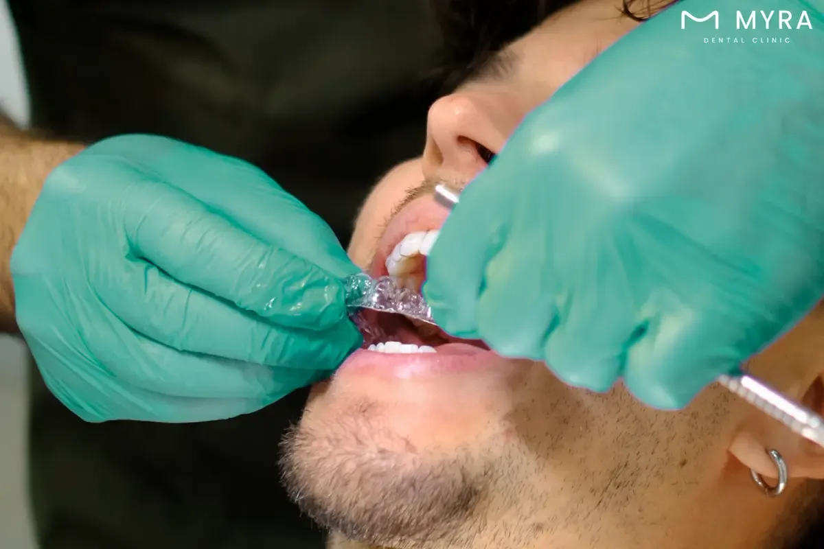 how do you properly fit a gum shield?