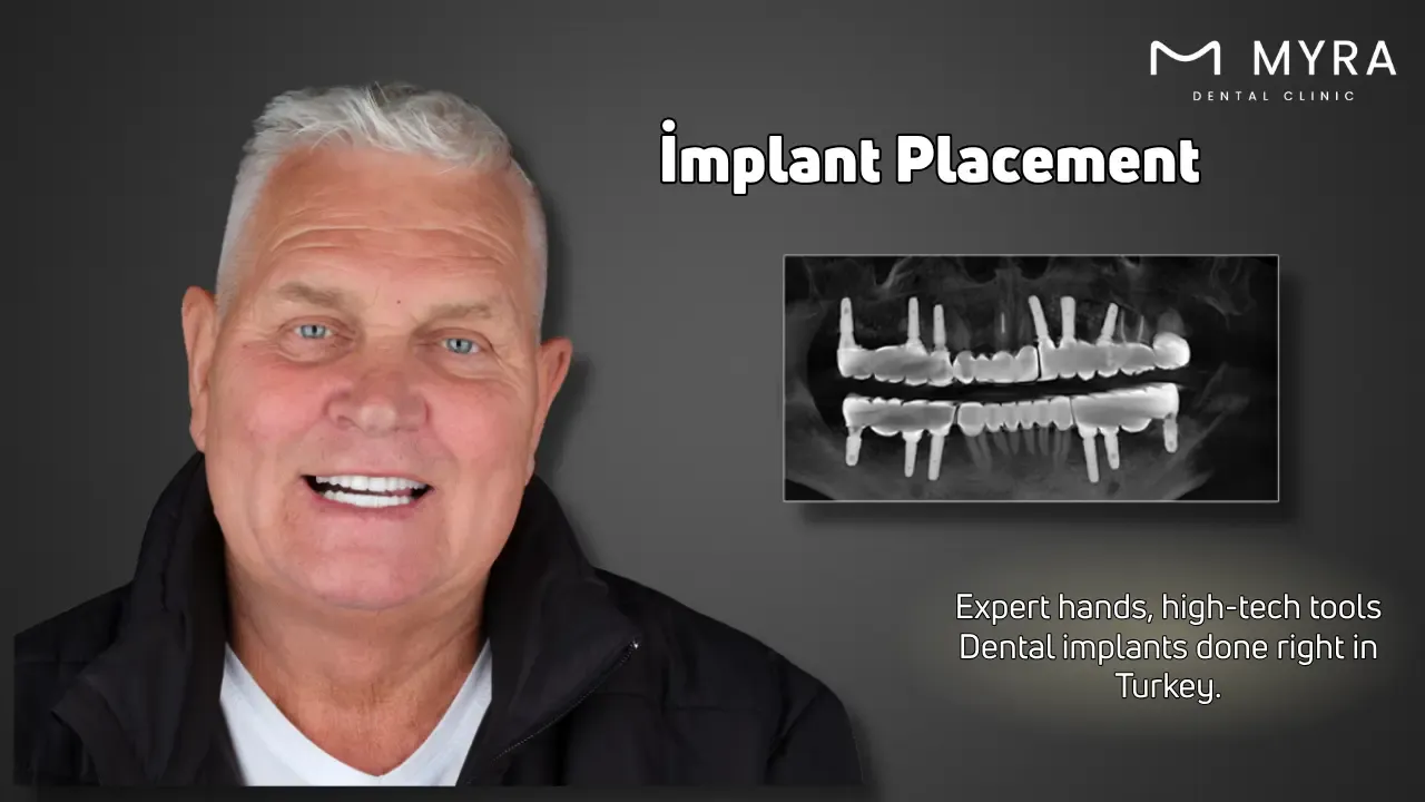 implant placement