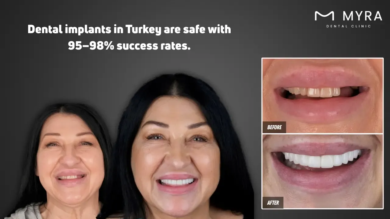 is it safe to get dental implants in turkey