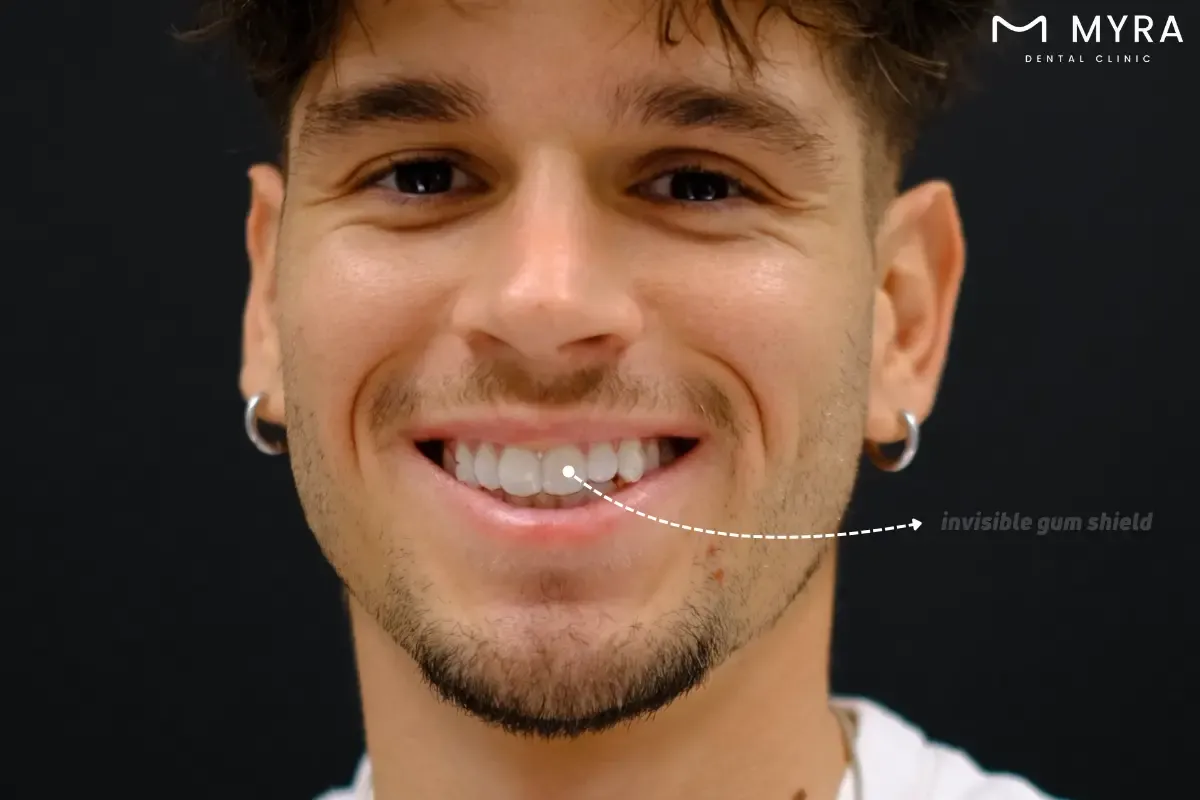 what are the advantages of a gum shield?