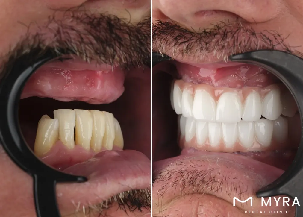 what are the different types of dentures available in the usa?