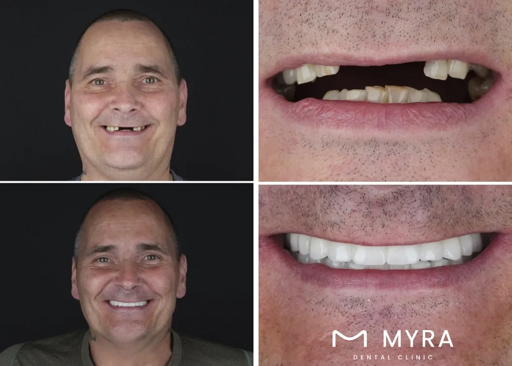 what types of dentures are most commonly available in turkey?