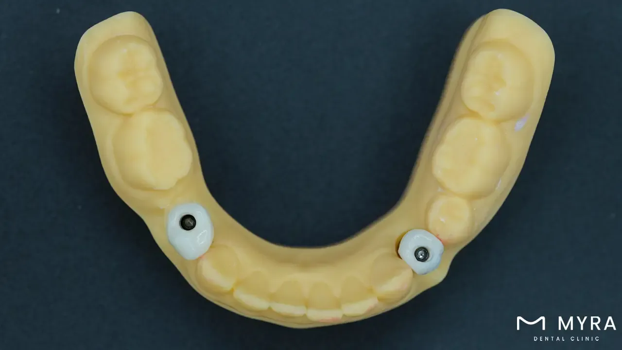 who can use a custom-made abutment?