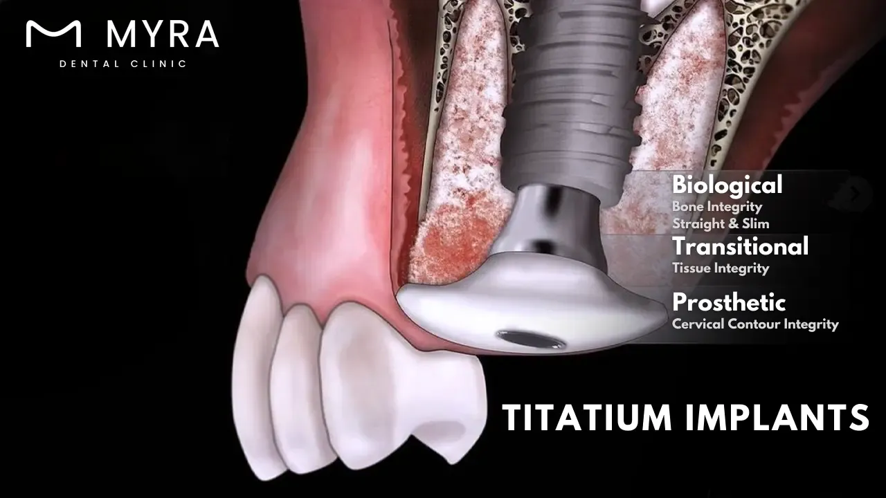 Why.is.Titanium.an.Ideal.Material.for.Dental.Implants.in.turkey.webp