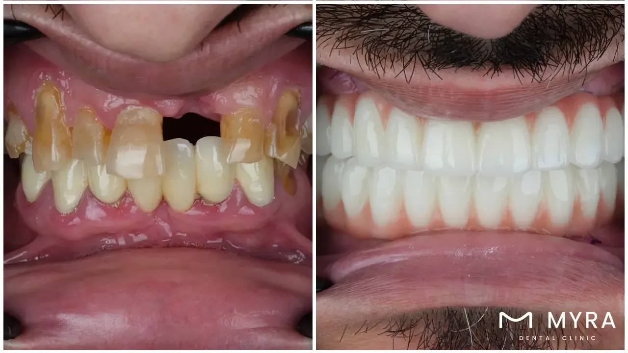 a complete understanding of all-on-4 dental implant