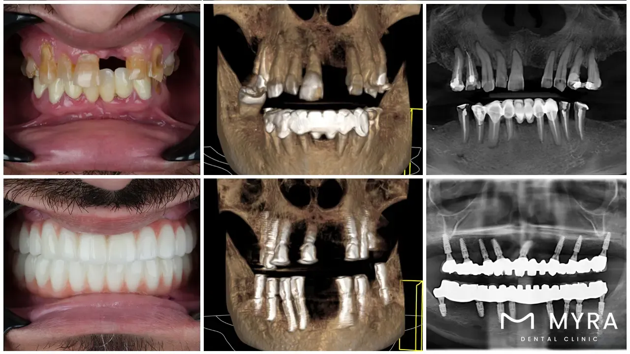 a complete understanding of all-on-4 dental implant 2