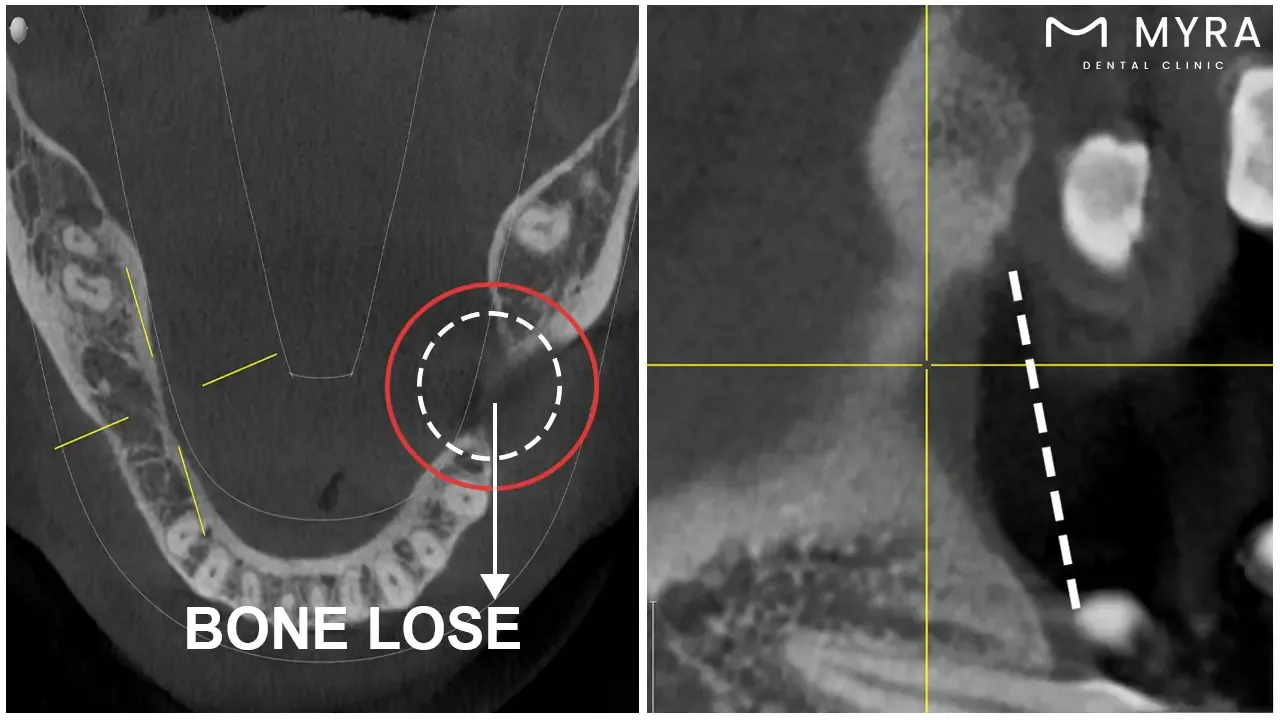 advanced bone grafting