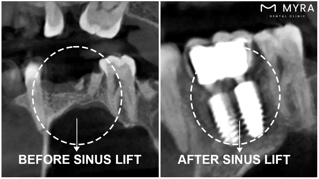 advanced sinus lift
