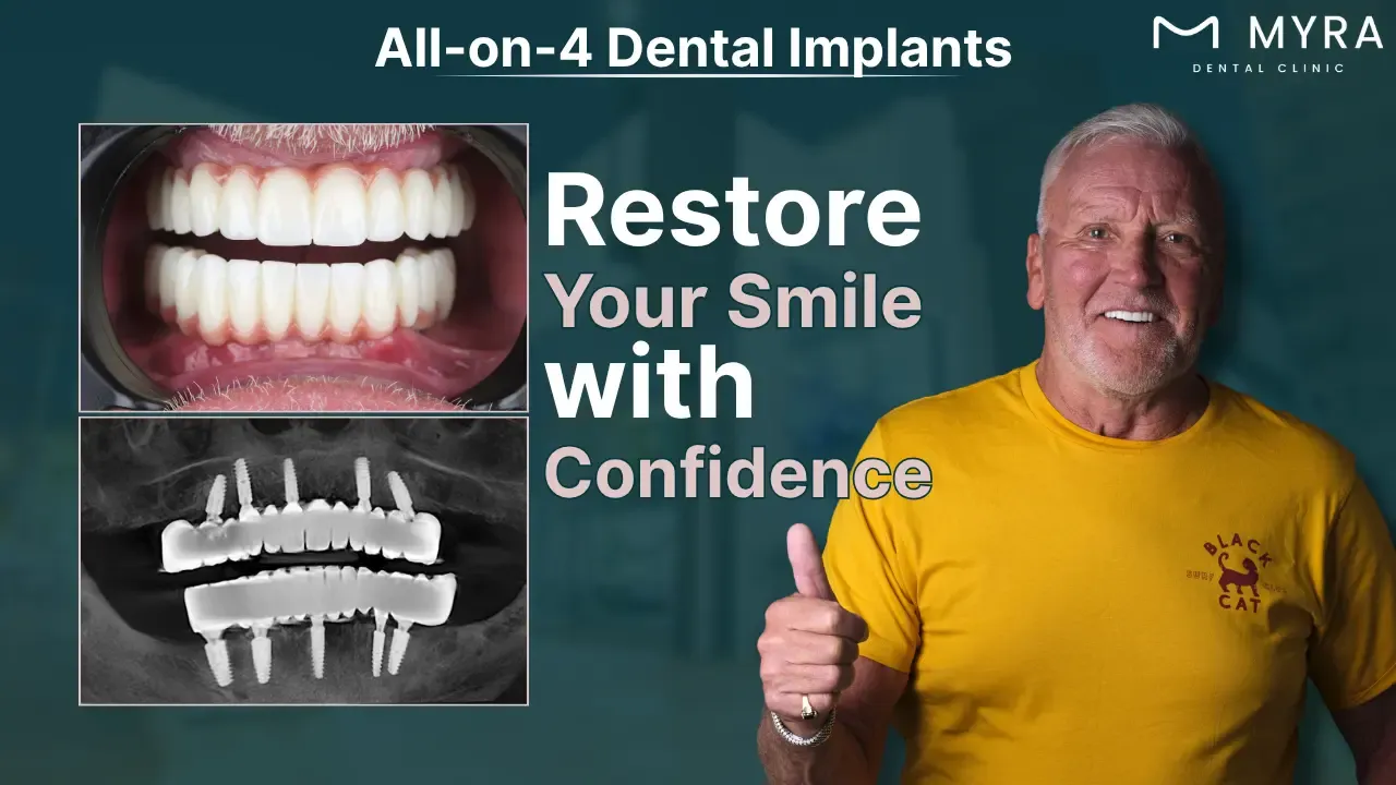 all-on-4 dental implants cost: how much are all-on-4 implants