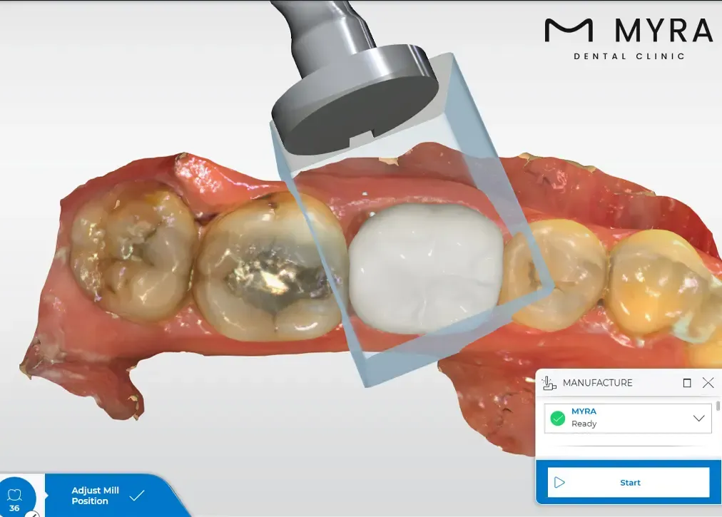 amalgam-fillings.webp
