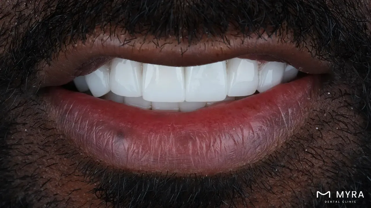 Amount of teeth showing at rest