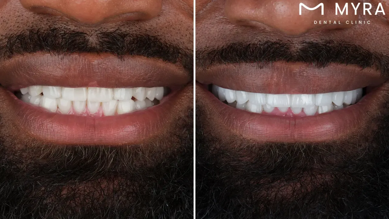 Are dental veneers suitable for everyone?