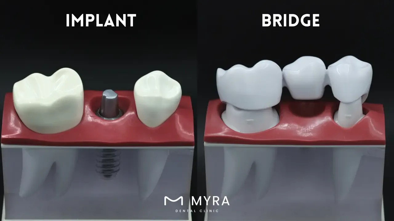 are there alternatives for dental implants