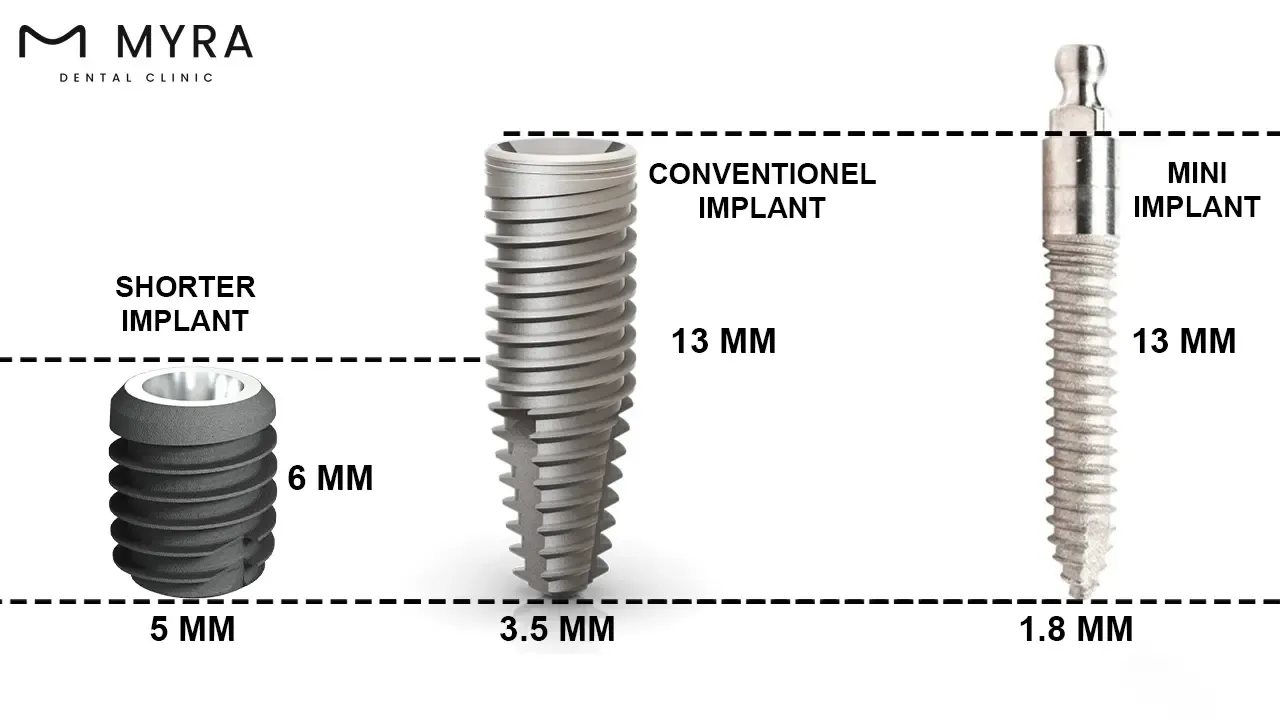 are there alternatives for mini dental implant