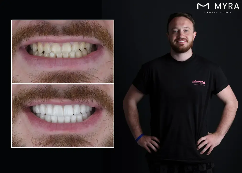 Are there any alternatives to zirconia veneers for restoring damaged teeth