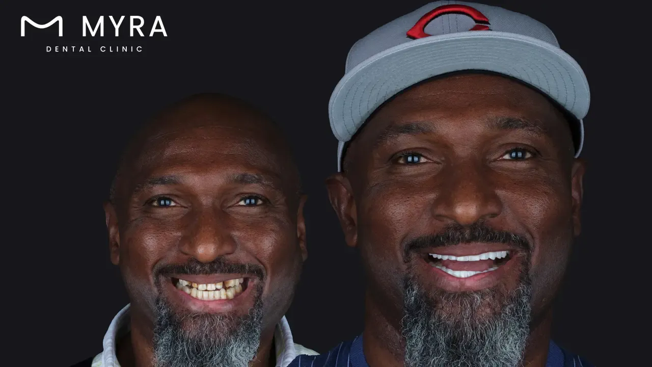 Are veneers expensive