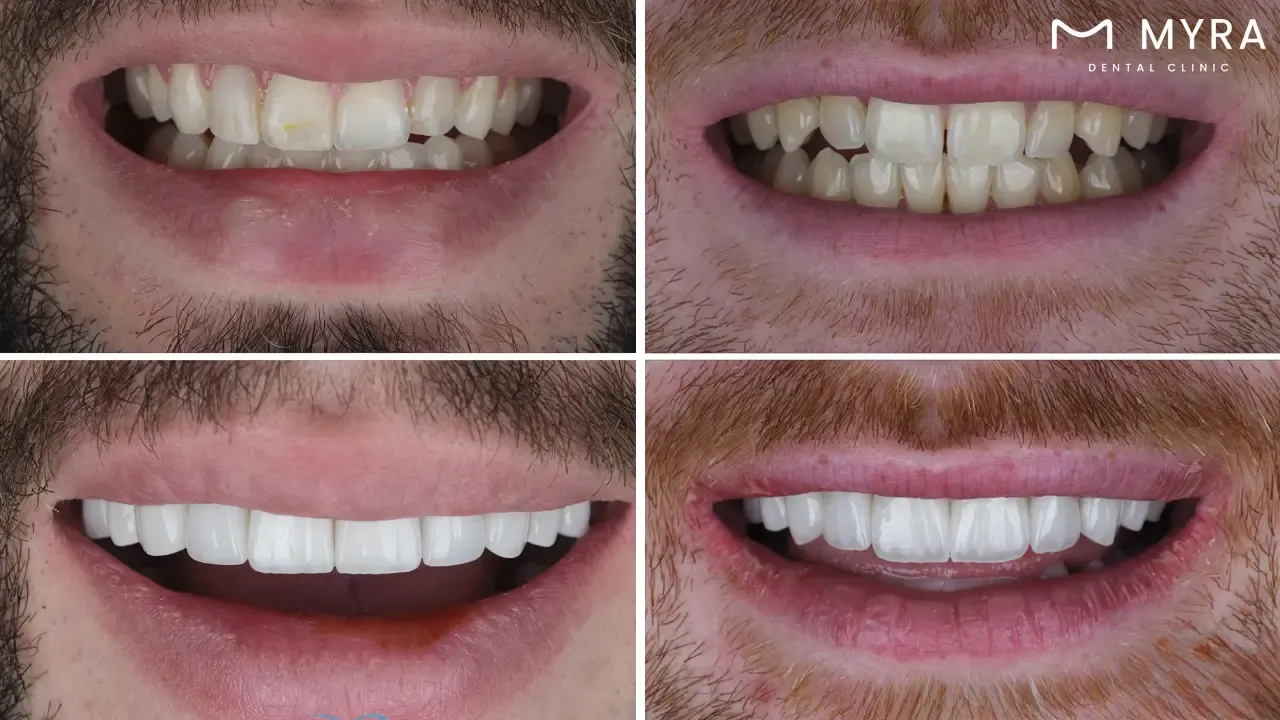 Before-after photos of turkey dental veneers