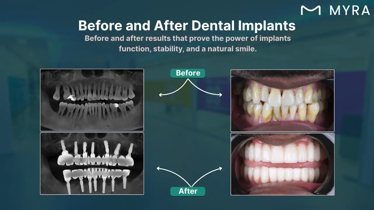 before-and-after-dental-implants.webp