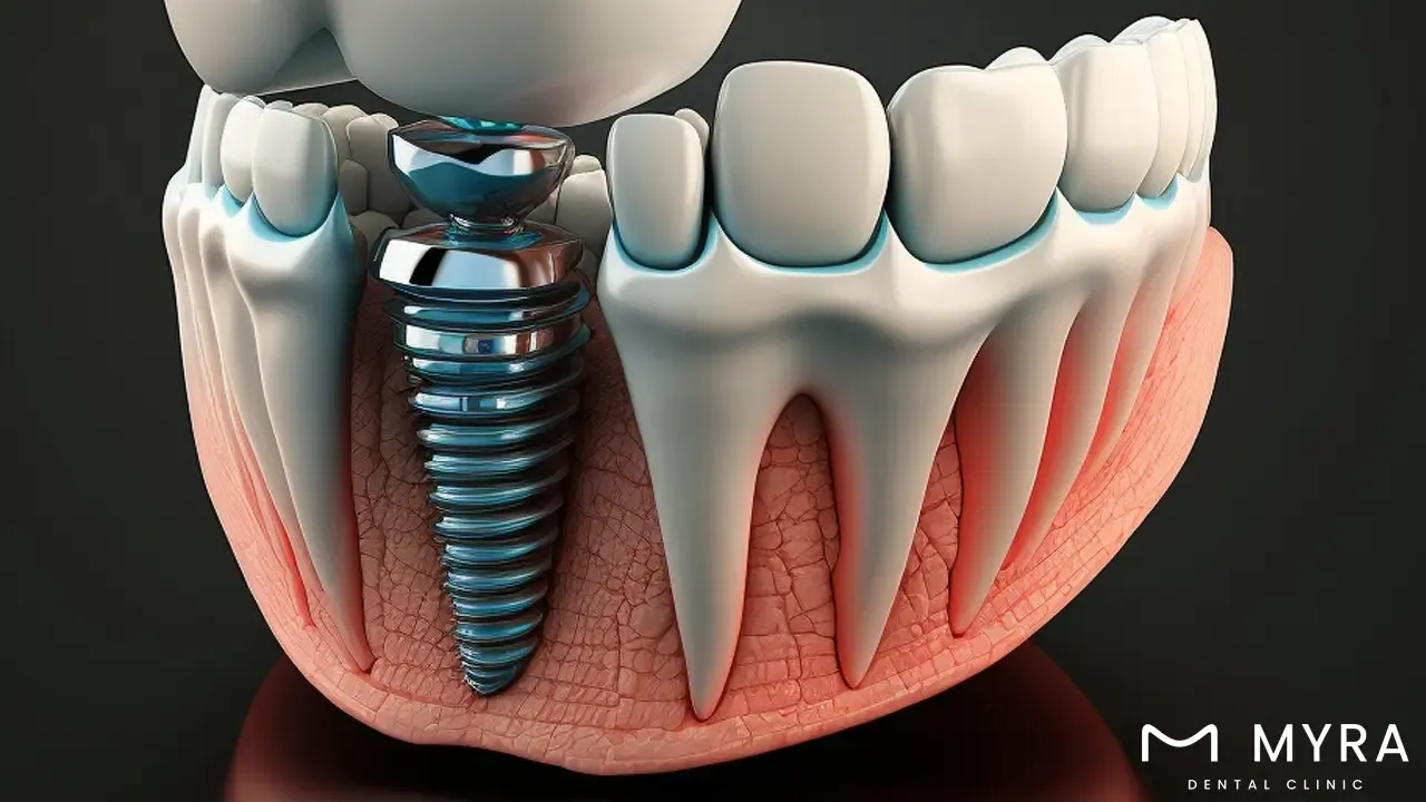 benefits of dental implants