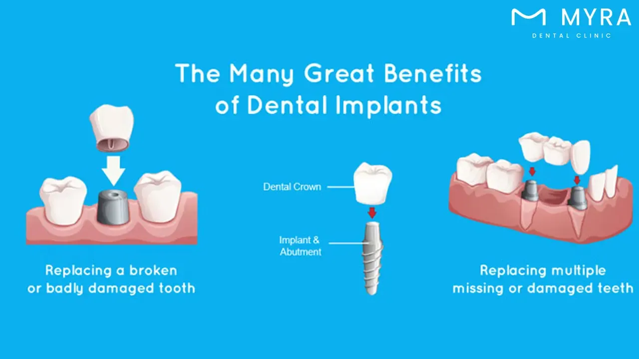 benefits of dental implants
