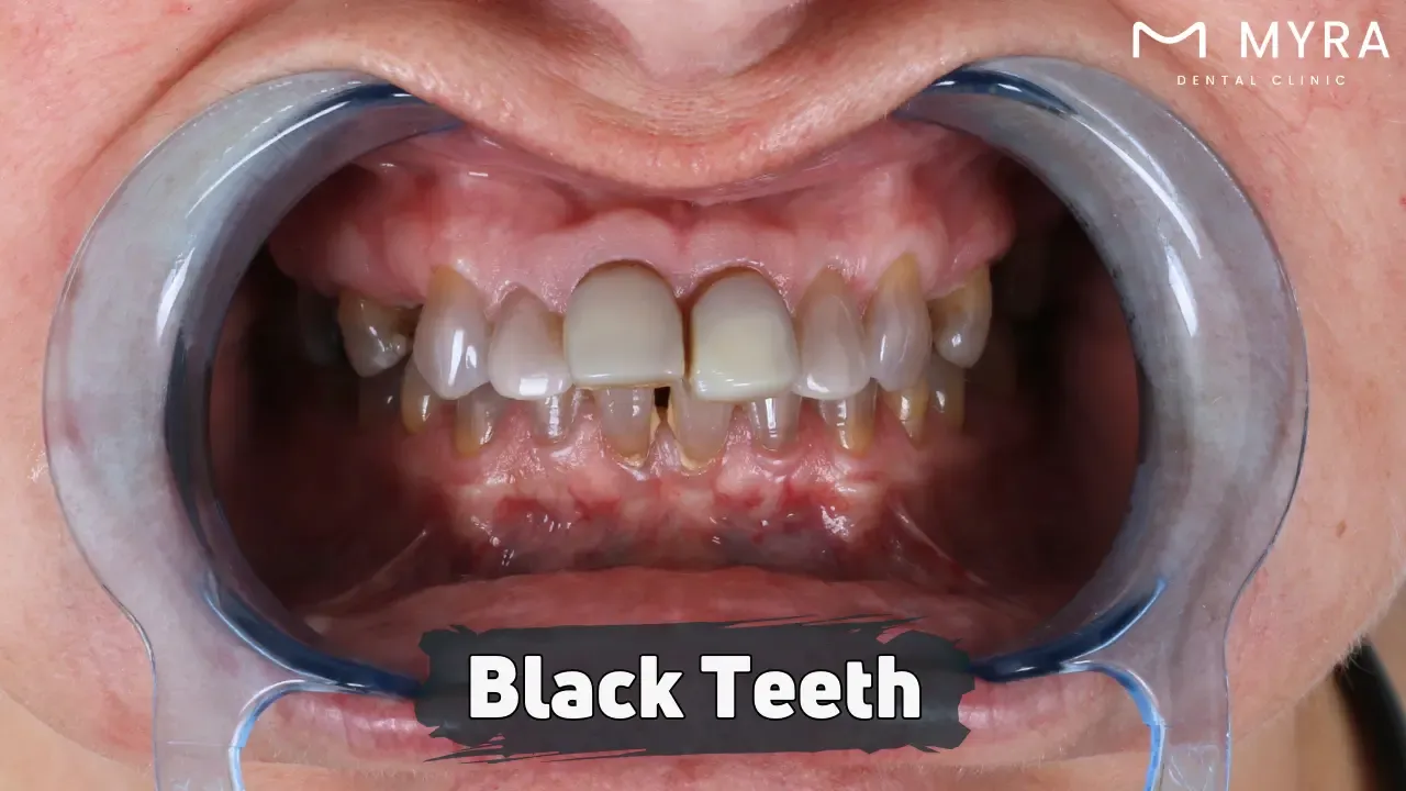 Black teeth: Causes, symptoms, treatments, and prevention