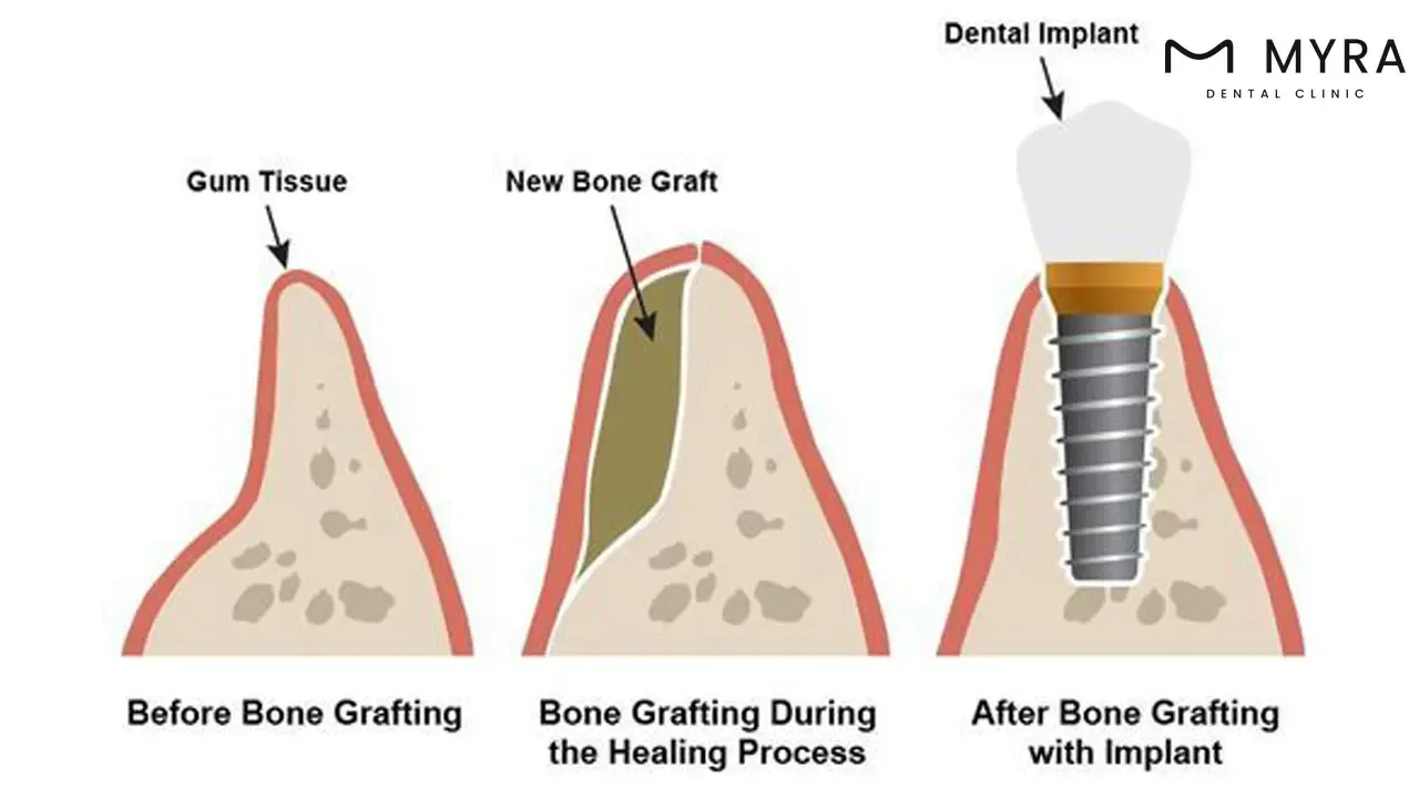 bone grafting healing