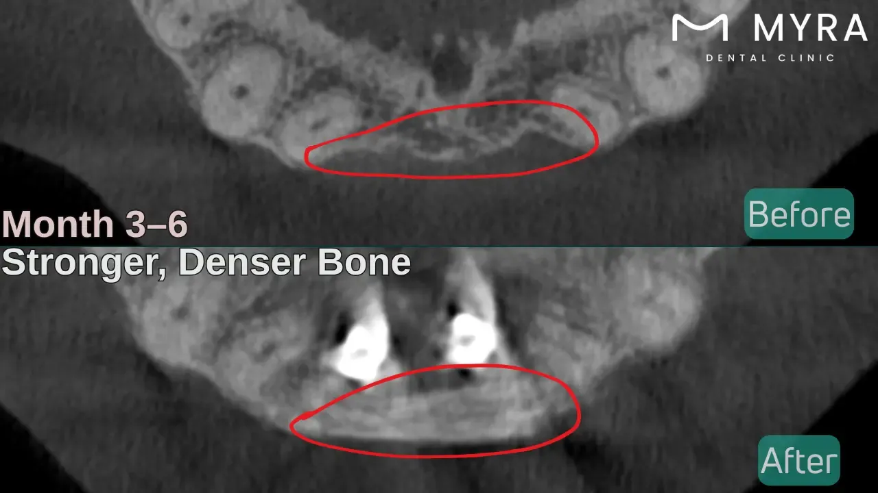 bone maturation after dental graft