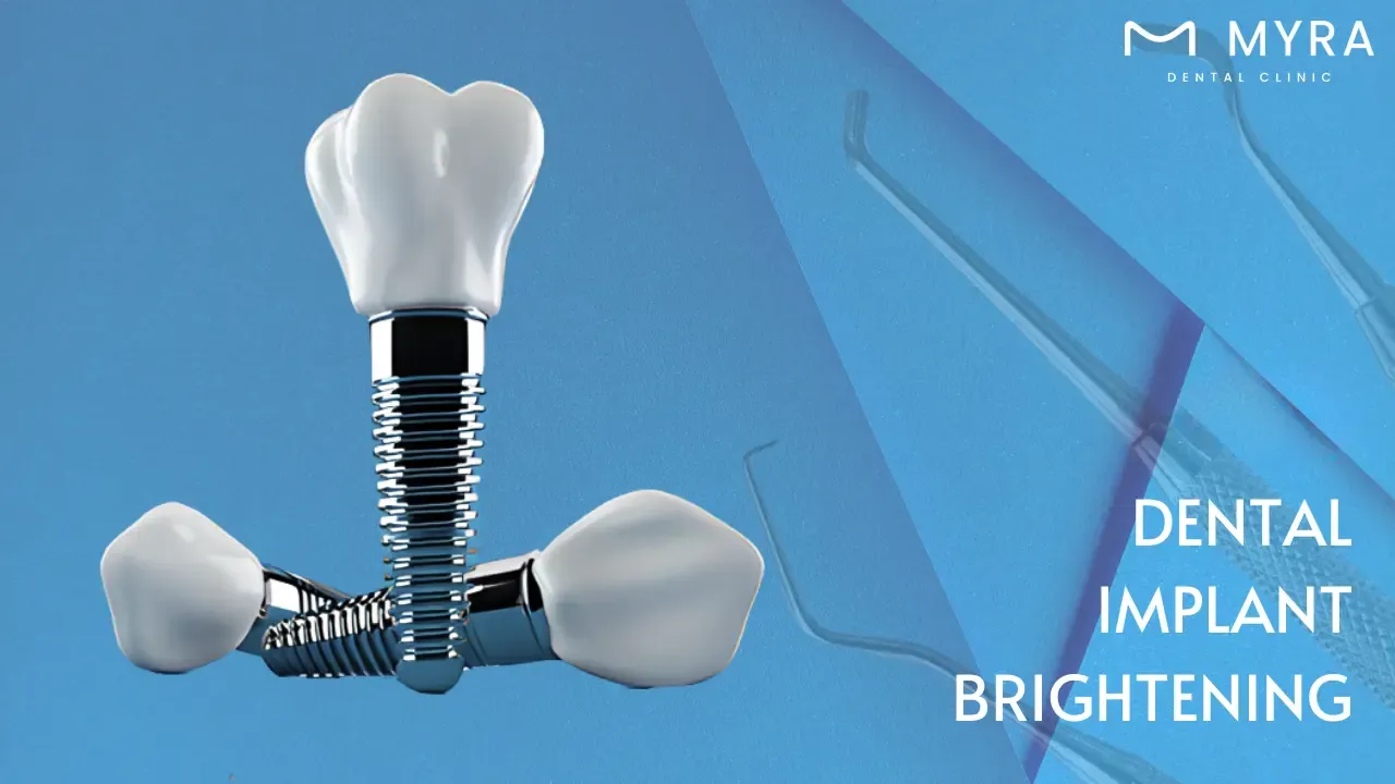 brightening-dental-implants-how-to-whiten-dental-implant.webp