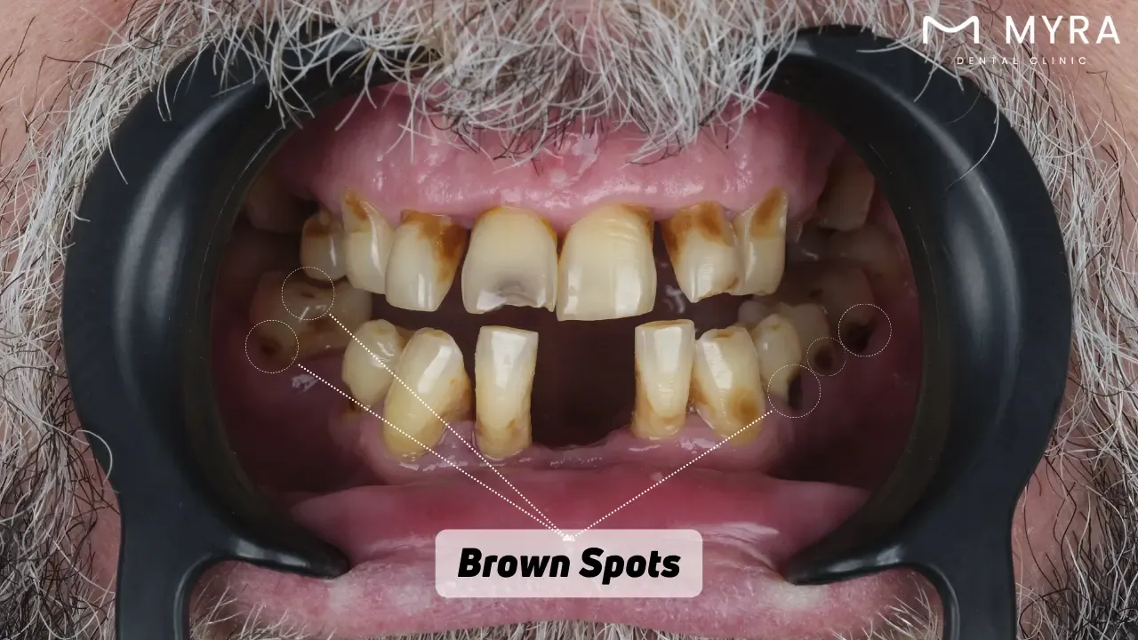 Brown spots on teeth: Causes, treatments, and prevention