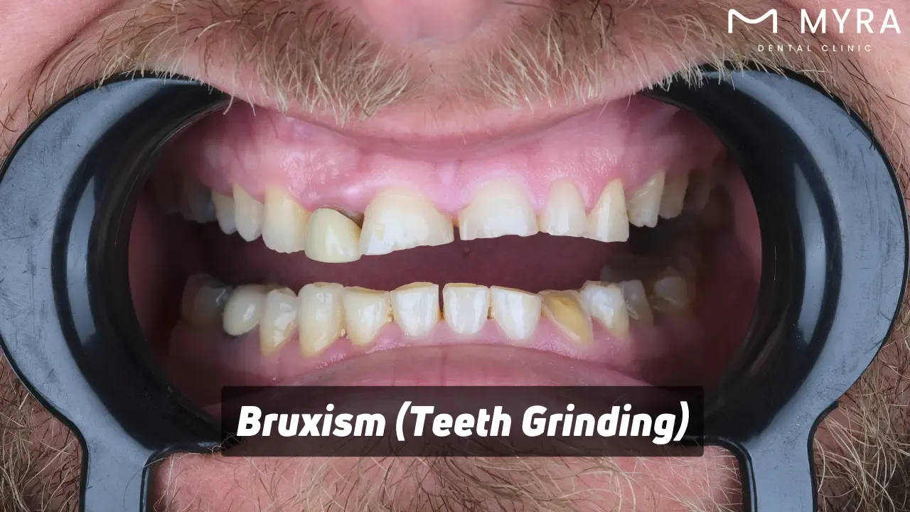 Bruxism (teeth grinding): Symptoms, treatment, and causes