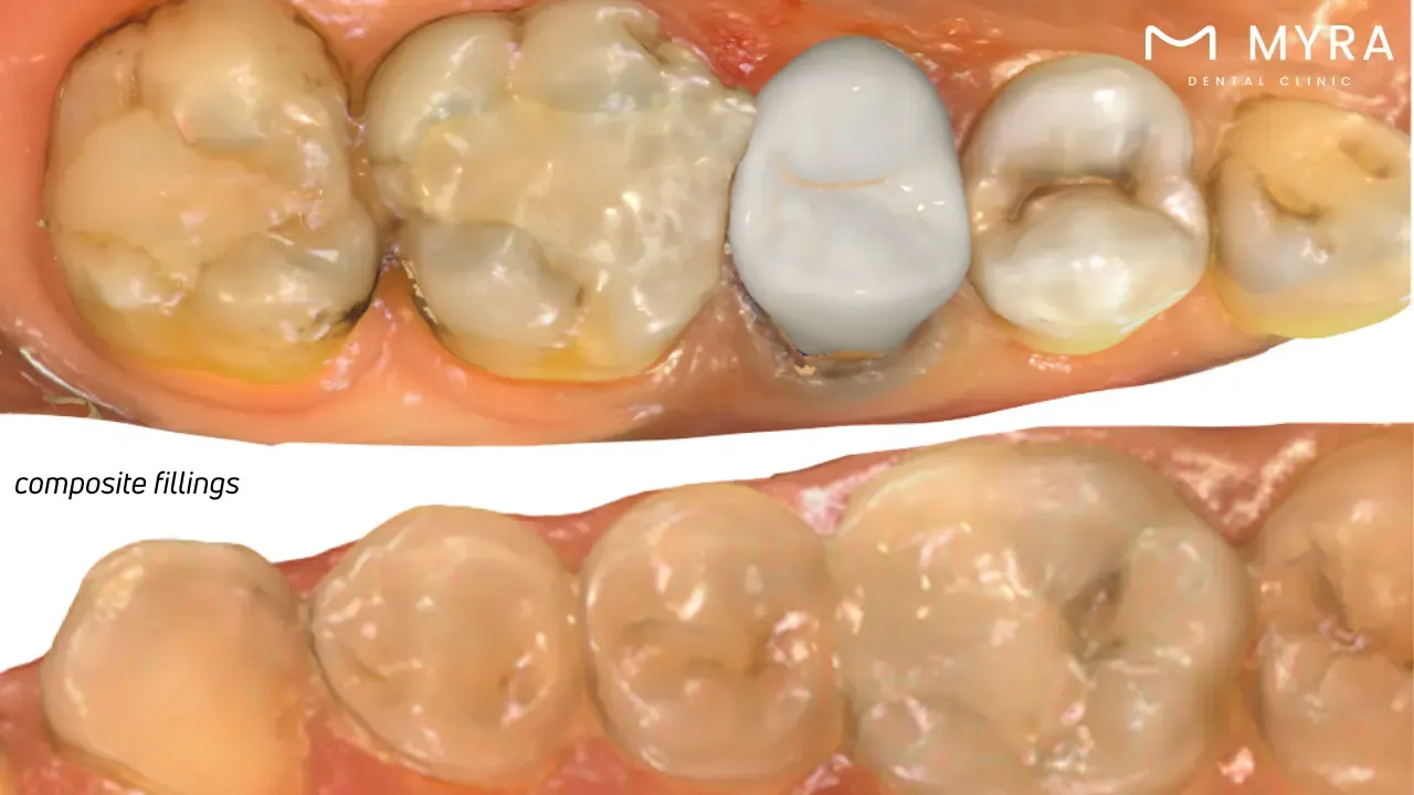 Can cavities be treated at home?