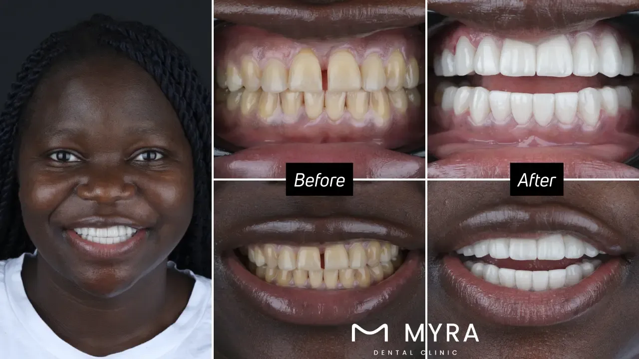 Can the "turkey teeth" procedure close the gap between teeth problem?