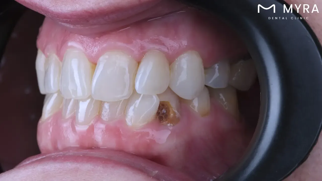 Can tooth decay be treated at home?