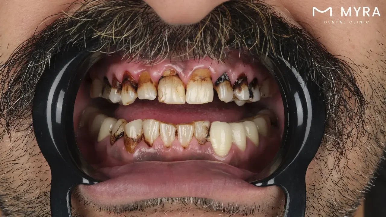 Cavities: Symptoms, treatment, and causes